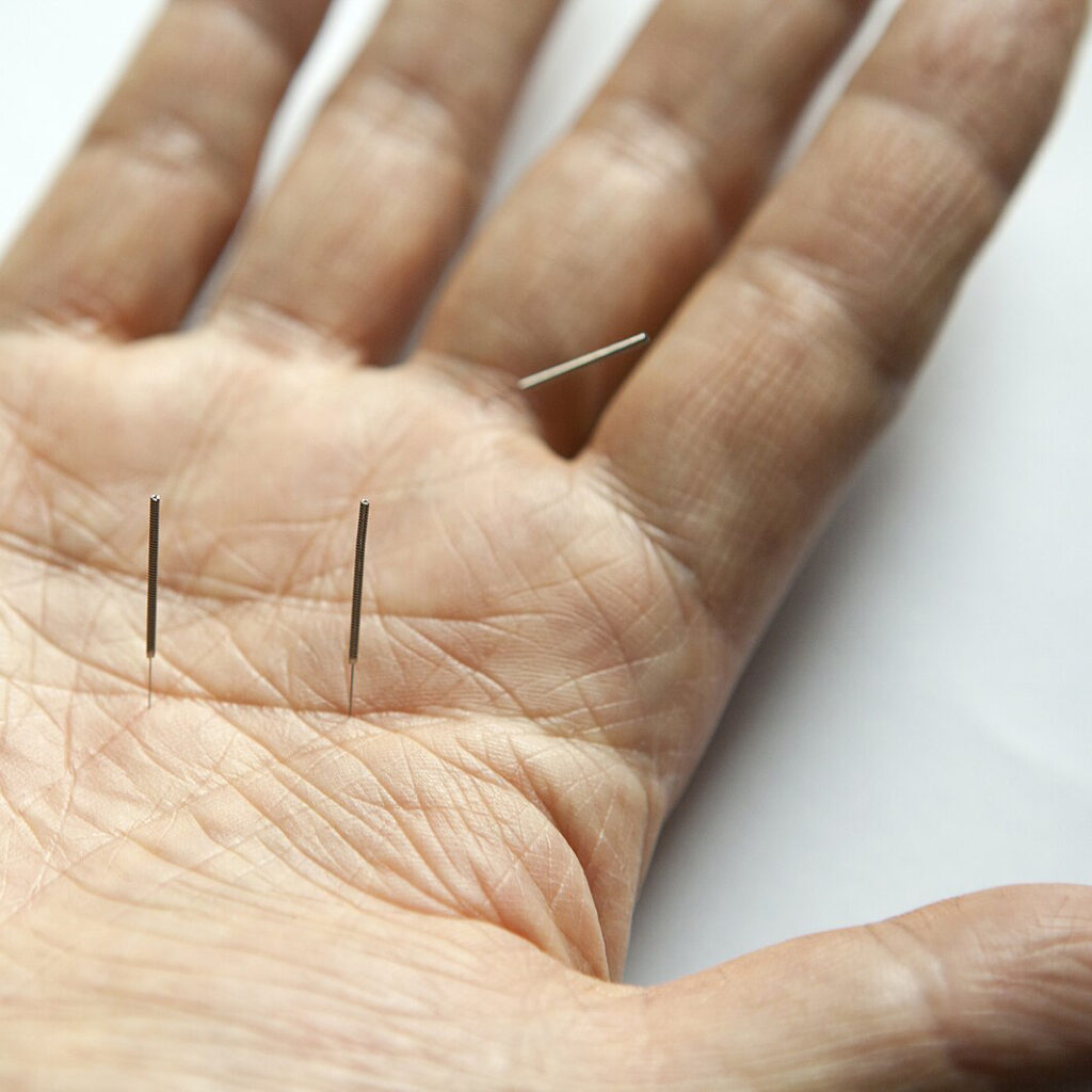 A hand with acupuncture needles